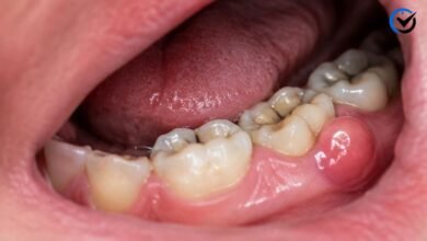 Hard Bump on Gums by Molar