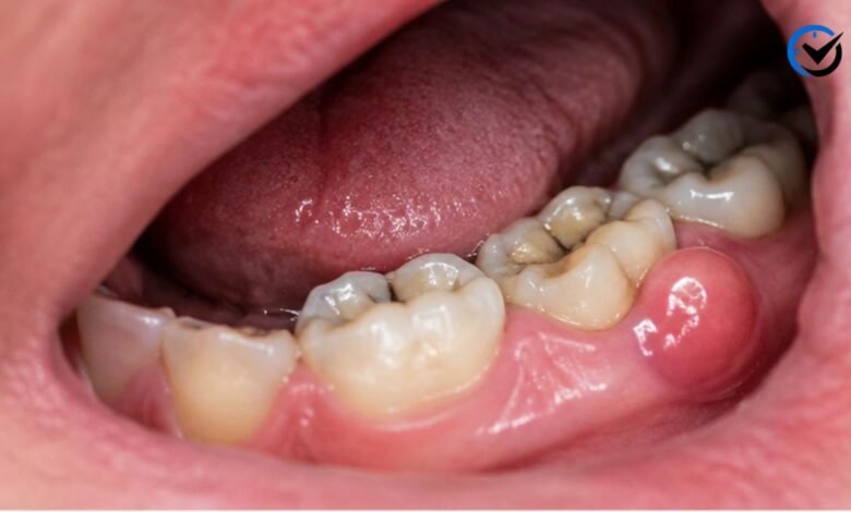 Hard Bump on Gums by Molar